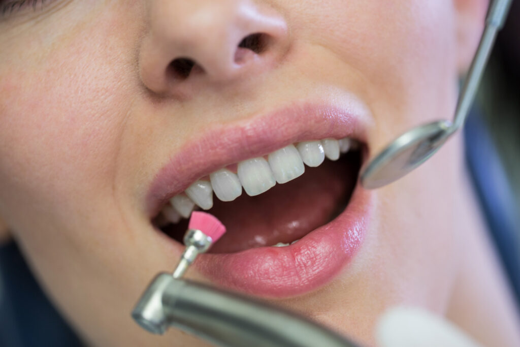 How does porcelain veneer work